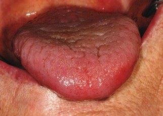 glosodinie