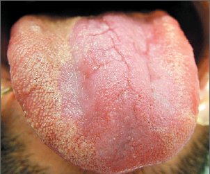 boala, celiaca, glosita, limba, eritematoasa