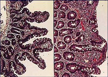 bariera, intestinala, sanatoasa, afectata